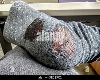 Worn-out sock on mans foot, close-up of damaged fabric and holes, everyday life detail showing clothing wear and tear and hygiene concept. Poor man Stock Photo