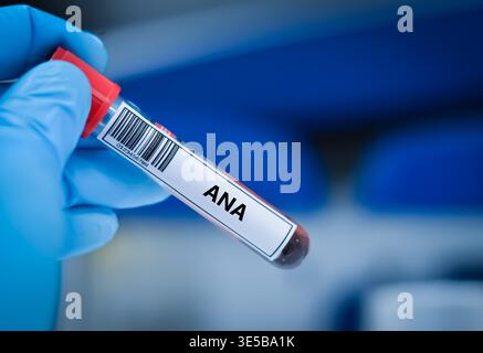 Blood sample tube for anti-nuclear antibody test analysis. Stock Photo