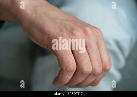 Male hand skin affected by dryness, skin reaction shows signs of dehydration and requires treatment. Stock Photo