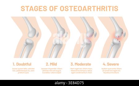 Infographics of knee joint osteoarthritis stages Stock Vector