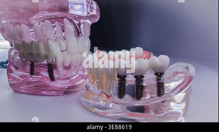 Dental implant model with ceramic bridge on lower jaw Stock Photo