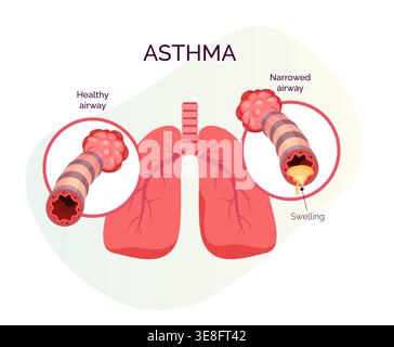 Chronic Inflammation, swelling, and increased mucus production in the bronchial airways - Stock Illustration as EPS 10 File Stock Vector