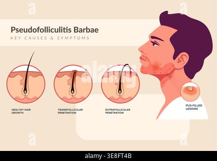 Pseudofolliculitis Barbae - Key causes & Symptoms - Stock Illustration as EPS 10 File Stock Vector