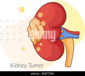 Kidney Tumor a Abnormal Growth - Stock Illustration as EPS 10 File Stock Vector