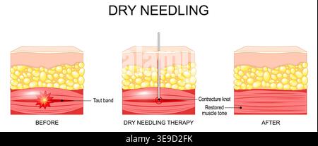 Dry needling. Skin and Muscle before and after dry needling therapy. Taut band, Contracture knot, Restored muscle tone. myofascial trigger point deact Stock Vector