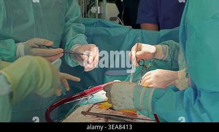 Surgical team performing operation in hospital. Close-up of surgeons hands using medical instruments during an operation in a hospital operating room Stock Photo