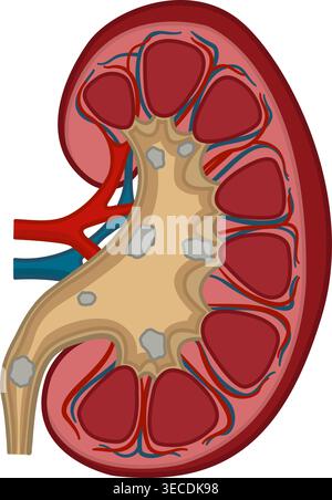 Anatomy of Kidney Stones. Medical Concept of Urinary System Disease. Vector Illustration of Human Internal Organs Stock Vector