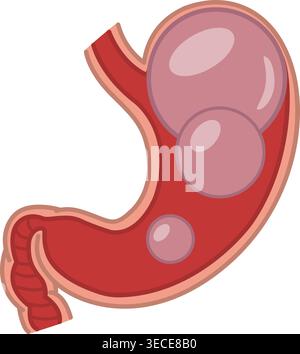 Bloating. Stomach disorder and disease, Gas problems. Vector Illustration of Human Internal Organs. Anatomy and Medicine Stock Vector