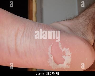 Close-up of a male foot with peeling skin. Avitaminosis. Disease. Dry problematic skin on the feet. People who heel cracks. Health care concept. Stock Photo