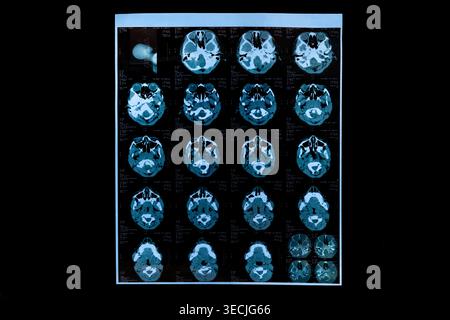 Brain ct scan imaging aids in medical diagnosis and neurological assessment Stock Photo