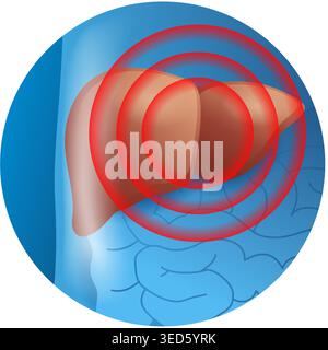 Liver with pain circles 3D icon - against hepatitis or other liver disease. Vector illustration Stock Vector