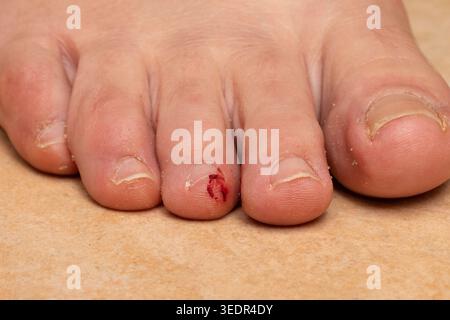 Human foot with a bleeding wound on the middle toe, close-up view Stock Photo