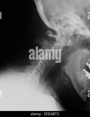 Lateral X-ray imaging showing cervical spine vertebrae, skull, and jaw, providing a detailed medical view of the human neck and surrounding skeletal s Stock Photo