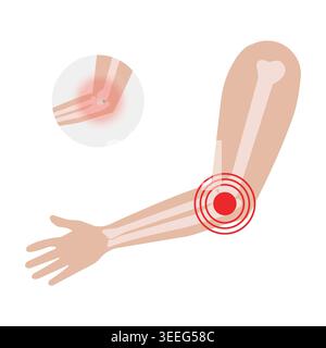 Flat vector illustration showing elbow joint pain, bone anatomy, inflammation, and orthopedic healthcare concepts in a clean medical style. Stock Vector