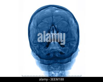 Detailed x-ray frontal view of human skull bones for clinical and educational purposes. Stock Photo