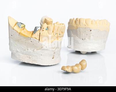 Detailed laboratory dental cast with a finished prosthetic bridge ready for installation, illustrating the technical stages of prosthodontics Stock Photo