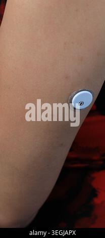 Close Up of Woman Wearing Continuous Glucose Monitor CGM Sensor on Arm for Diabetes Tracking Stock Photo