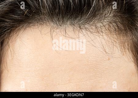 Close-up of new short baby hairs growing on a womans scalp after hair loss treatment. Stock Photo