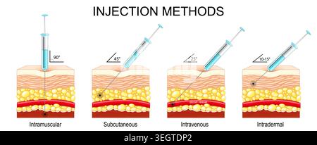 Injection technique. Needle angle. Cross section of human Skin layers ...