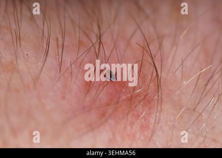 Nymph Castor bean tick, sheep ked, sheep tick, Ixodes ricinus sucks blood. On the skin of an arm. Family Ticks, Ixodidae. Spring, May, Netherlands. Stock Photo