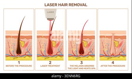 Laser hair removal infographic. Epilation, irradiation and burning of hair follicle, radiation pulses effects, medical skincare, follicle structure Stock Vector