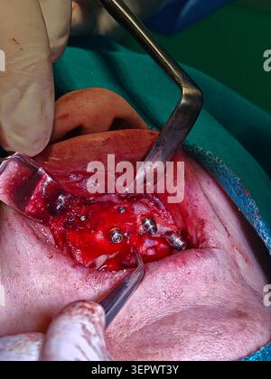 Dental Implant Surgery Intraoral View Showing Multiple Jaw Implants And Surgical Instruments Stock Photo