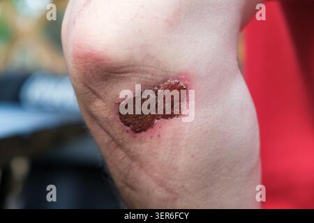 Body wound. Close-up of a scraped elbow with a healing scab, outdoors. High quality photo Stock Photo