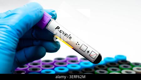Blood sample of patient positive result for plasmodium ovale. Stock Photo