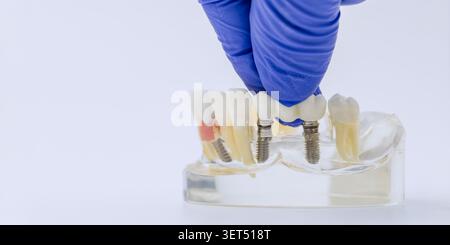 Implant Supported Bridge Installation on Dental Jaw Model Stock Photo