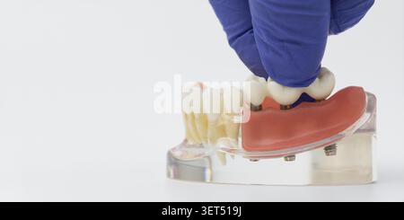 Implant Supported Prosthetic Bridge Installation on Jaw Model Stock Photo