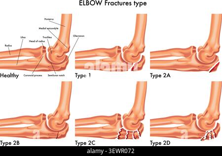 Medical illustration showing the various types of elbow fracture Stock Vector