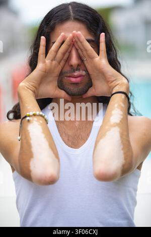 Close-up of a Middle Eastern man with vitiligo covering his eyes with hands, wearing a white tank top outdoors, highlighting skin diversity, self-prot Stock Photo