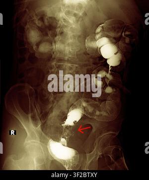 Coloured barium enema X-ray showing sigmoid colon cancer. A barium enema is a contrast radiography technique in which barium sulphate is ingested to outline the colon on X-ray. The scan demonstrates the classic 'apple core sign' in the sigmoid region, a characteristic appearance caused by circumferential narrowing of the colon lumen due to a ring-like colorectal carcinoma (colon cancer). Treatment may include surgery, chemotherapy and radiotherapy depending on the stage of the disease. Stock Photo