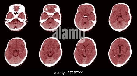 Coloured computed tomography (CT) scan of the head showing the white cerebellum sign, indicative of severe hypoxic ischaemic brain injury. The white cerebellum sign refers to the appearance of the cerebellum, the region of the brain at the back of the skull responsible for coordination and balance, as relatively hyperdense (brighter) compared to other parts of the brain on a non-contrast CT scan. It is a recognised indicator of severe global hypoxic ischaemic brain injury, most commonly seen following cardiac arrest or prolonged hypoxia. The prognosis in such cases is generally very poor. Stock Photo