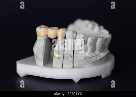 Three-unit dental bridge on plaster dental model for prosthetic restoration Stock Photo