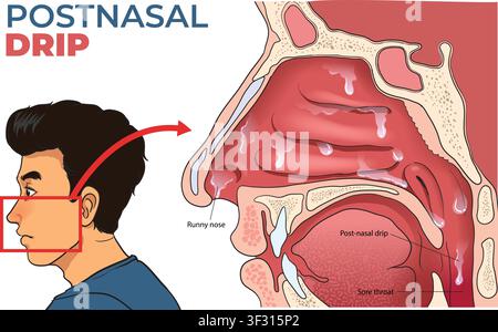 Medical illustration showing post-nasal drip and nasal congestion anatomy diagram vector Stock Vector