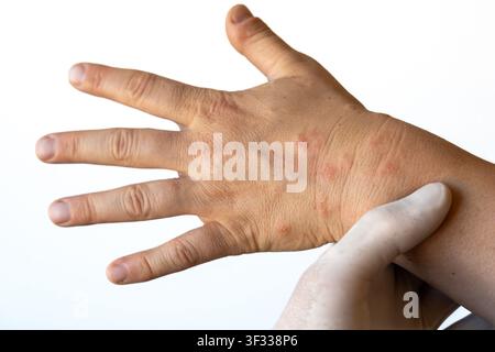 Eczema on human hand close-up showing dry, red, inflamed skin Stock Photo
