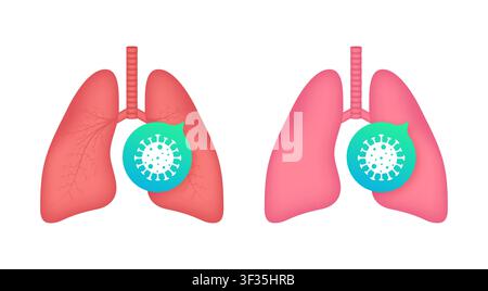 Human lungs affected and protected from coronavirus infection Stock Vector