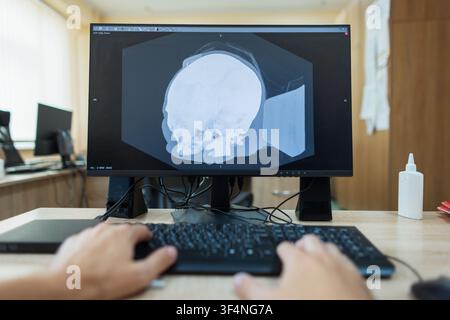 professional neurosurgeon is working at a computer. First-person view of a doctor typing on a keyboard while reviewing a 3D human skull reconstruction Stock Photo