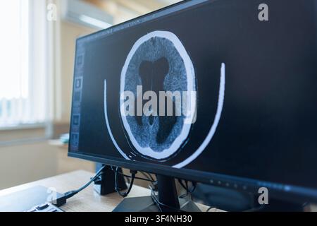 A computer monitor in a diagnostic clinic displays an axial brain CT scan showing enlarged ventricles or hydrocephalus pathology, illustrating advance Stock Photo