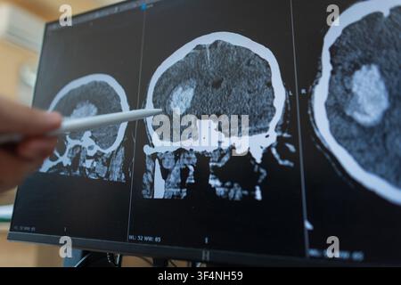A close-up of a doctor's hand pointing with a pen at a computer monitor screen showing several brain CT scan cross-sections with a large tumor or stro Stock Photo