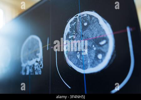 Angled close-up of a computer screen displaying a medical brain CT scan with alignment grid lines for advanced radiological diagnosis, neuroscience re Stock Photo