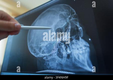 close-up of a doctor's hand pointing with a pen at a computer monitor screen displaying a lateral x-ray radiograph of a human skull during a medical o Stock Photo