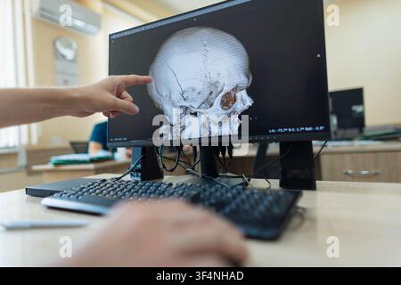 professional neurosurgeon is working at a computer. hand points at a 3D CT scan reconstruction of a human skull on a computer monitor, showing a sever Stock Photo