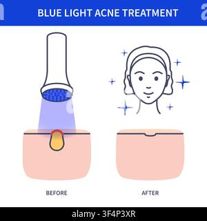 Blue Acne Face Chart Vector Illustration Stock Vector