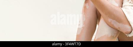 Close-up of female legs and arms with vitiligo patches, showcasing unique autoimmune skin pigmentation and texture, with copy space. This image highli Stock Photo