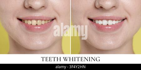 Teeth whitening, collage. Smiling woman before and after procedure, closeup Stock Photo