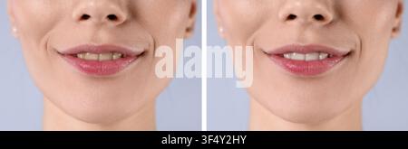 Teeth whitening, collage. Smiling woman before and after procedure, closeup Stock Photo