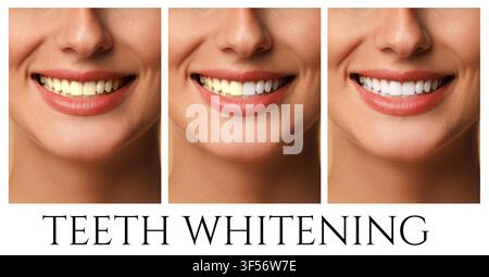 Teeth whitening, collage. Smiling woman before and after procedure, closeup Stock Photo