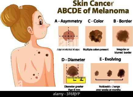 Educational vector diagram showing melanoma warning signs: asymmetry, irregular borders, varied color, diameter, evolving moles. Stock Vector
